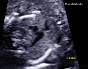 PA-IVS case 1